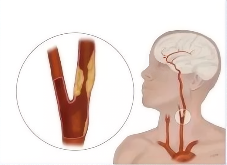 超千万中国人体检结果：两成有颈动脉斑块